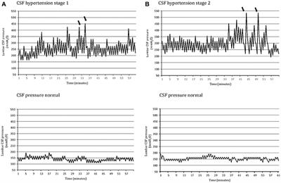 Cerebrospinal Fluid Pressure-Related Features in Chronic Headache: A Prospective Study and Potential Diagnostic Implications